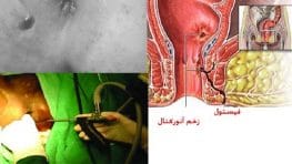 عکس فیستول مقعدی
