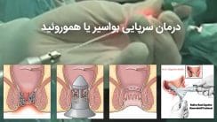 درمان سرپایی و سریع هموروئید یا بواسیر (رابربند،لیزر، و …) | درمان فوری درد بواسیر