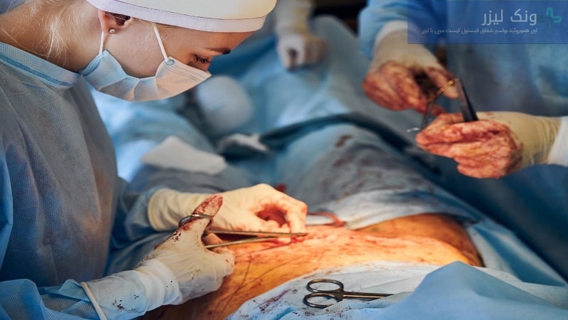 عمل جراحی کیست مویی به روش باز و بسته