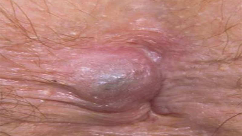 Female hemorrhoids