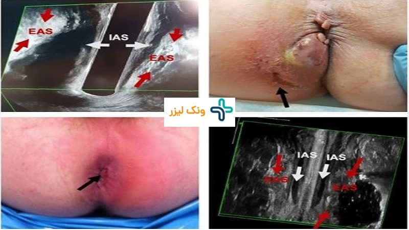 فیستول مقعدی بعد از جراحی
