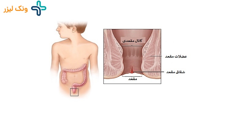 شقاق مقعدی در کودکان