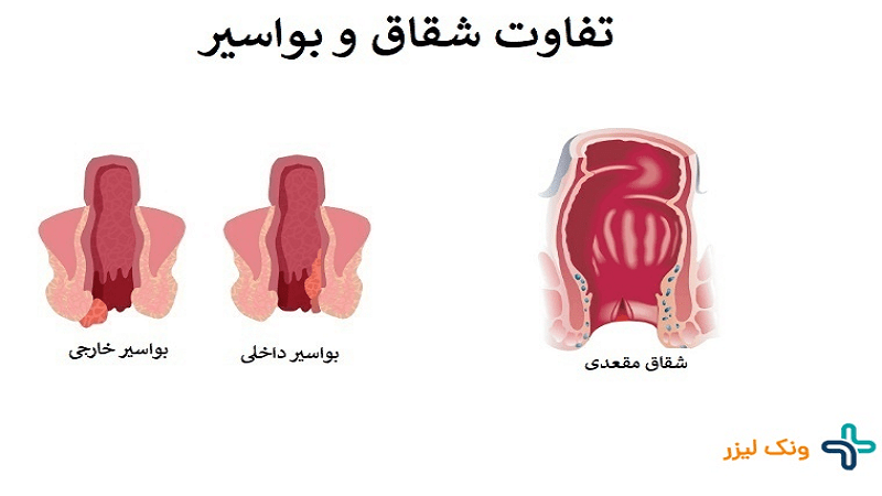 تفاوت شقاق و بواسیر