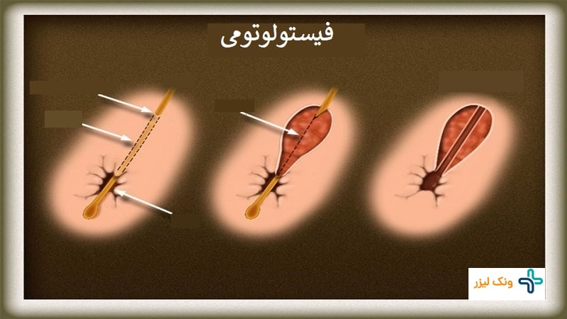 فیستولوتومی