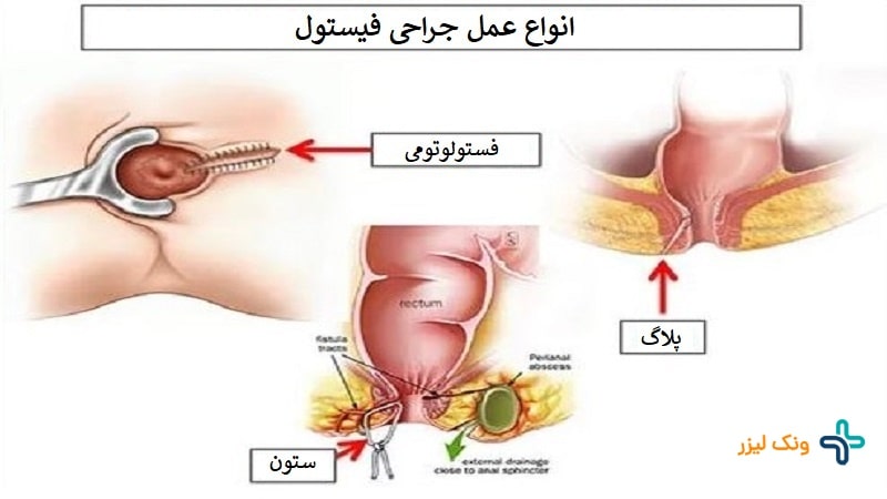 انواع عمل جراحی فیستول