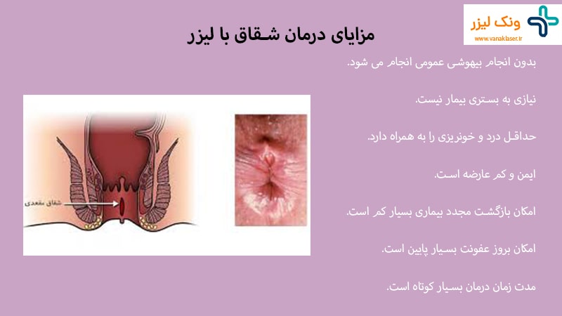 مزایای لیزر شقاق