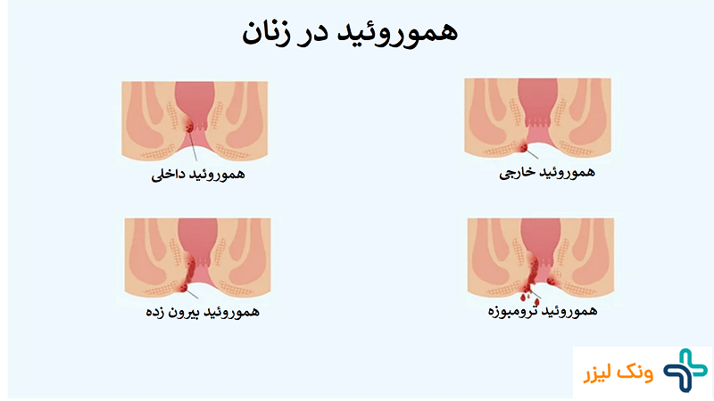 هموروئید در زنان چیست