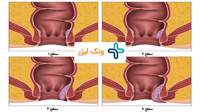 درجه بندی بواسیر