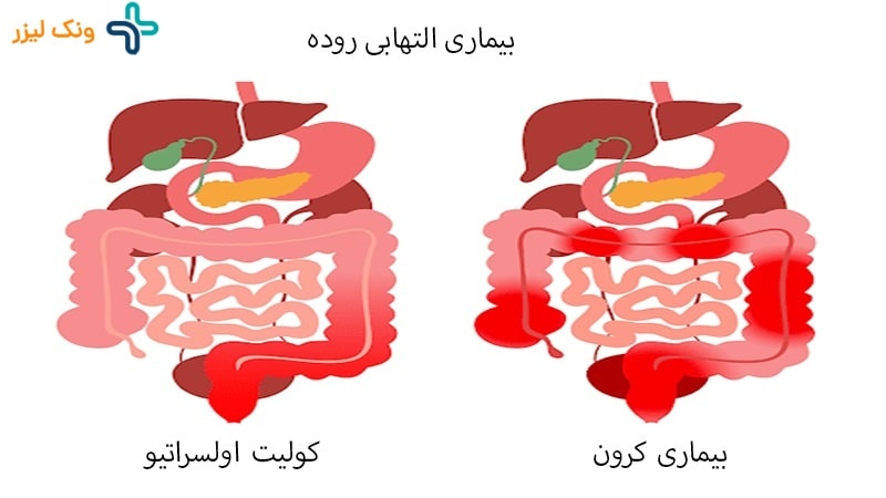 بیماری التهابی روده