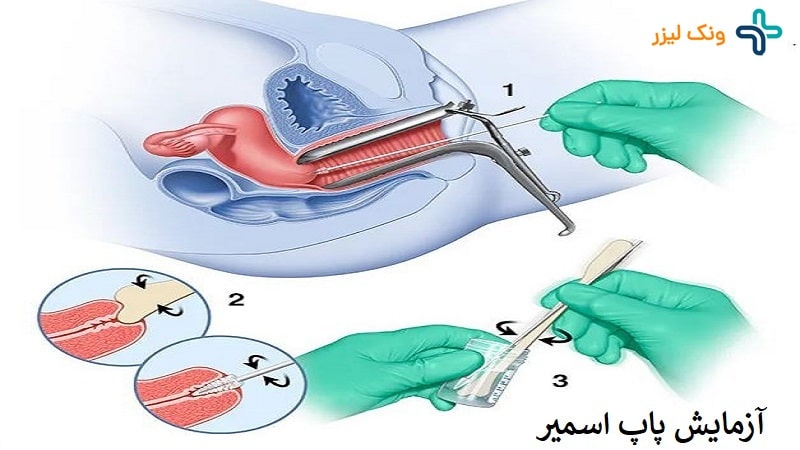 تشخیص و آزمایش زگیل تناسلی در زنان