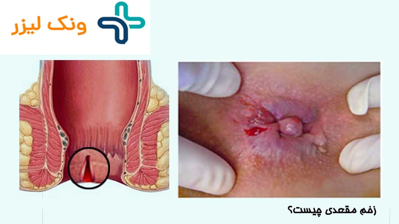 زخم مقعدی