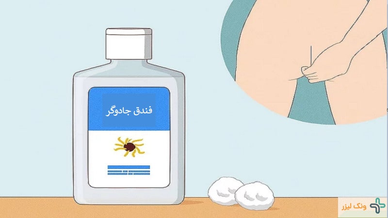فندق جادوگر برای بواسیر