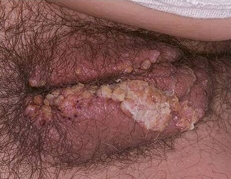 hpv عکس واضح از زگیل تناسلی زنان
