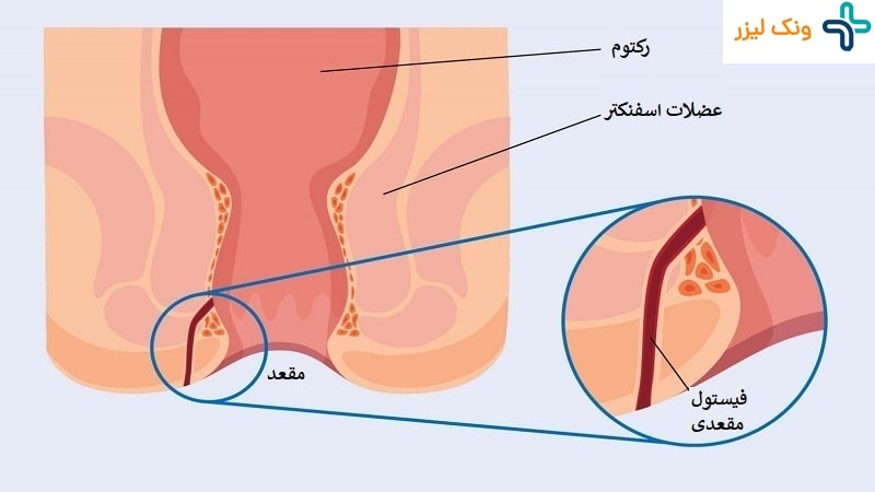 درمان فیستول مقعدی با دارو