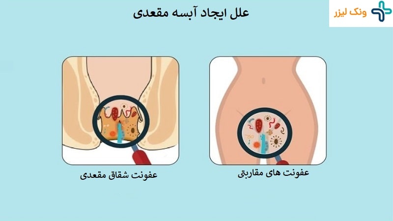 دلیل آبسه مقعدی