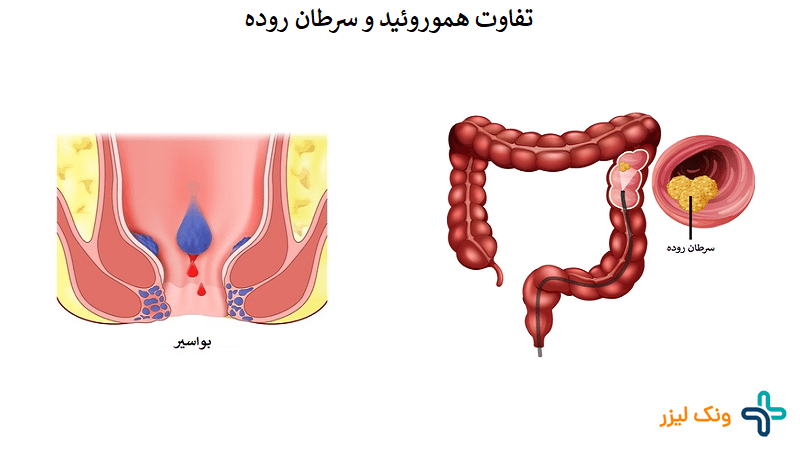 بواسیر و سرطان روده