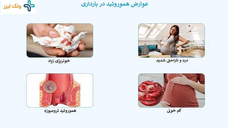 عوارض بواسیر در بارداری