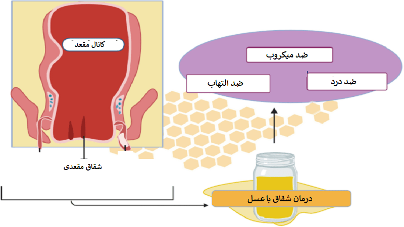 عسل برای درمان شقاق مقعدی