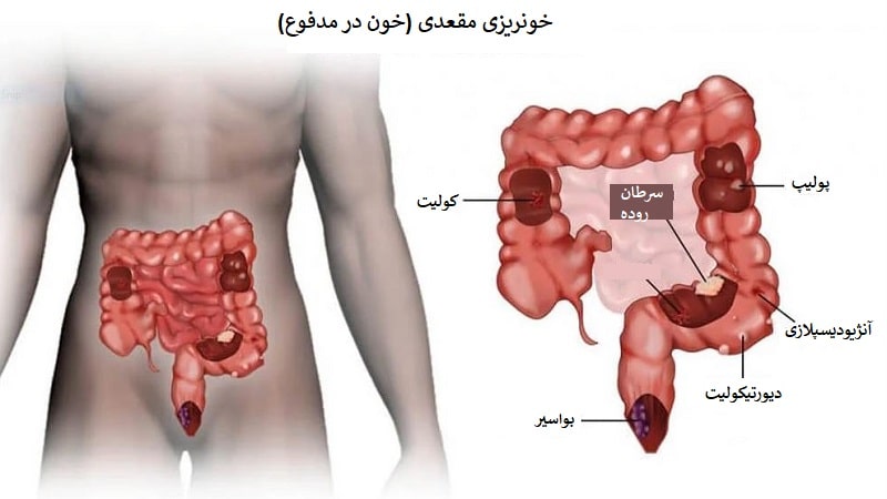 علت خون در مدفوع