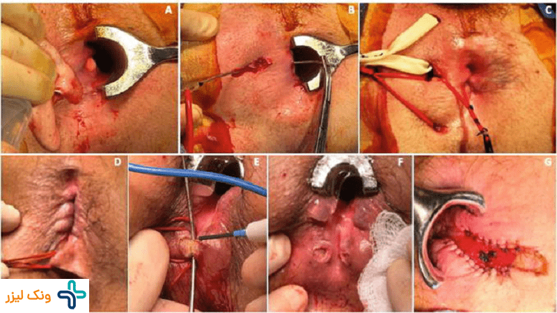 عکس جراحی فیستول مقعدی