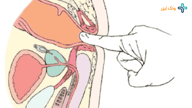 نحوه انجام دیلاتاسیون شقاق