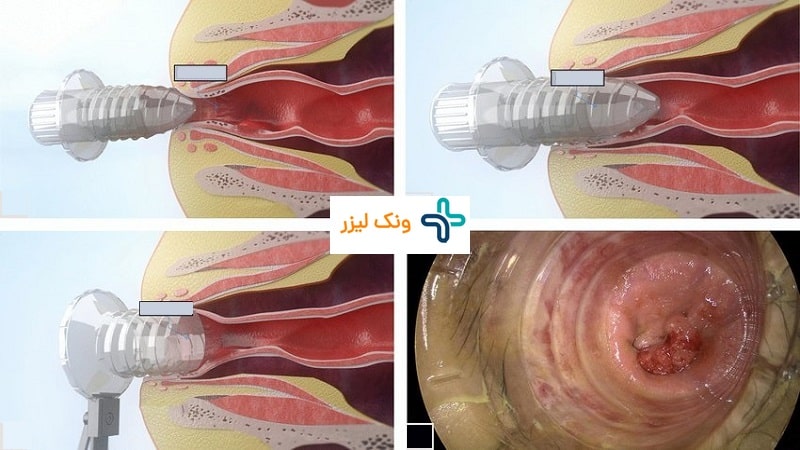 دیلاتاسیون شقاق