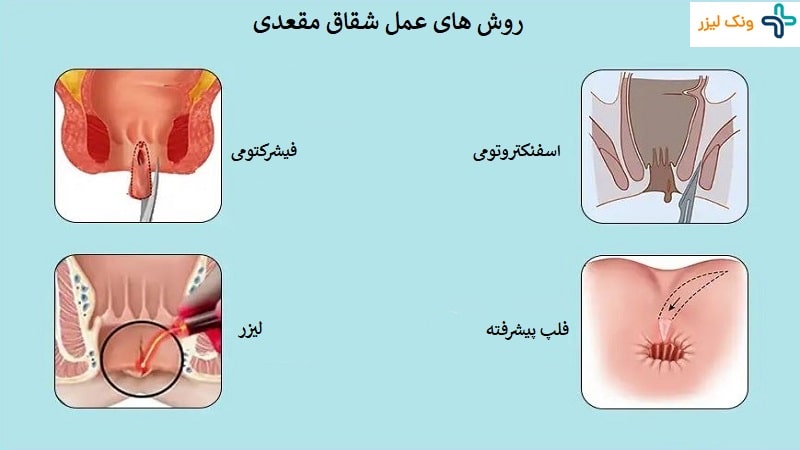 عمل شقاق مقعدی