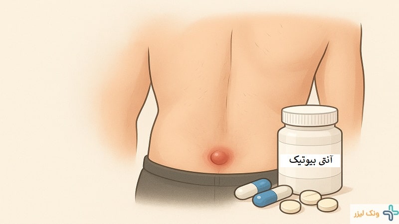 دارو برای کیست مویی