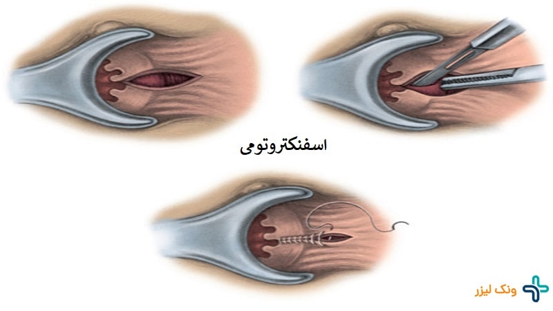 اسفنکتروتومی شقاق