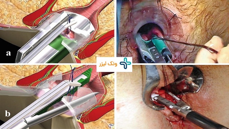 نحوه درمان فیستول مقعدی به روش VAAFT