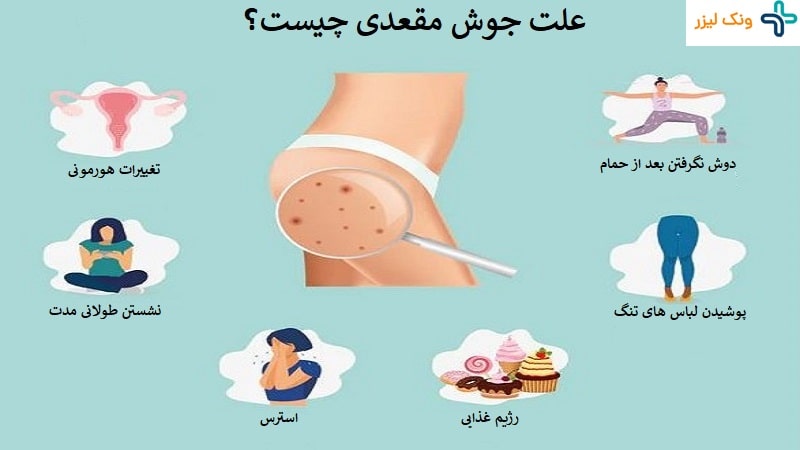 علت جوش مقعدی