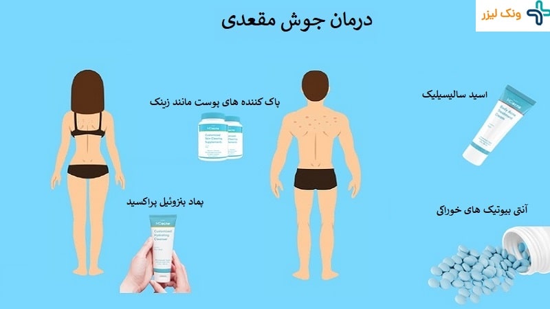 درمان جوش مقعدی