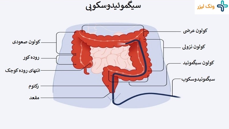 کاربرد سیگموئیدوسکوپی