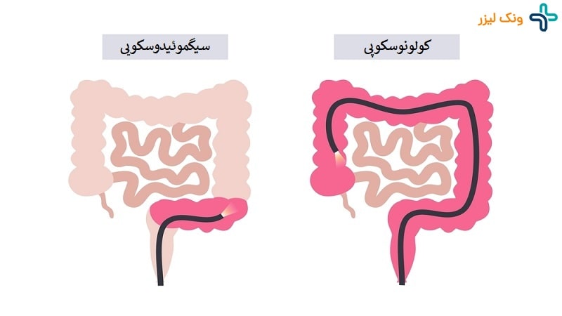 تفاوت سیگموئیدوسکوپی و کولونوسکوپی