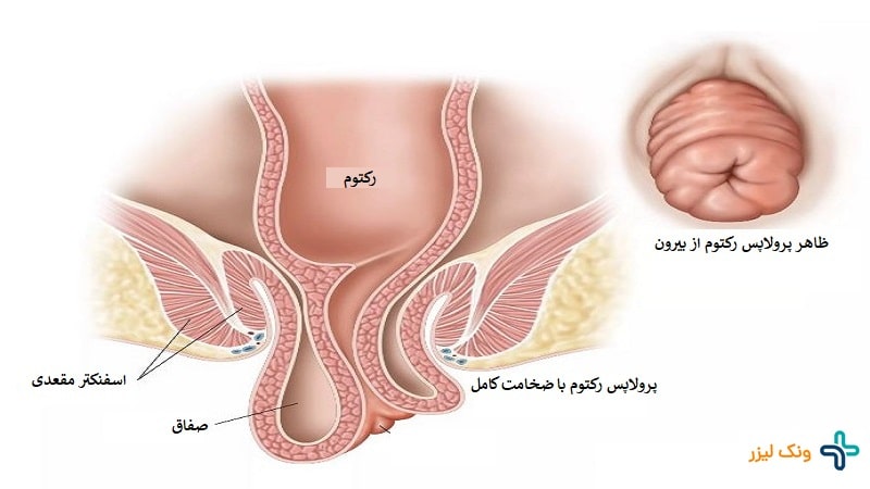 افتادگی راست روده