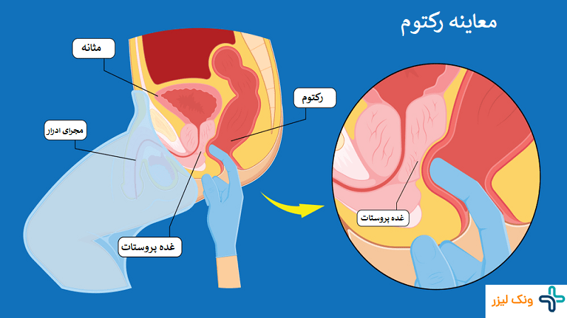 معاینه رکتوم