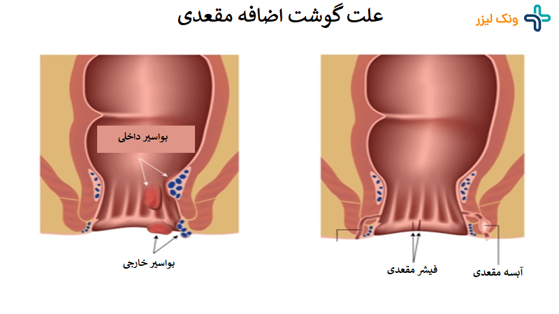 علت گوشت اضافه مقعدی