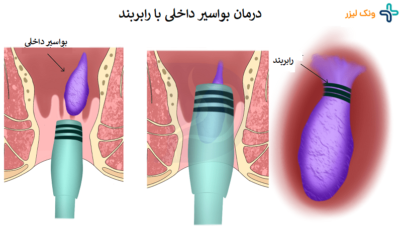 درمان بواسیر داخلی بدون جراحی