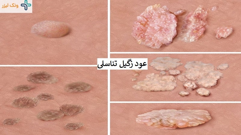 عود زگیل تناسلی