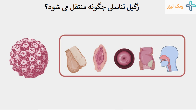 راه های انتقال زگیل تناسلی