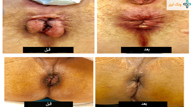 عکس هموروئید بعد از عمل