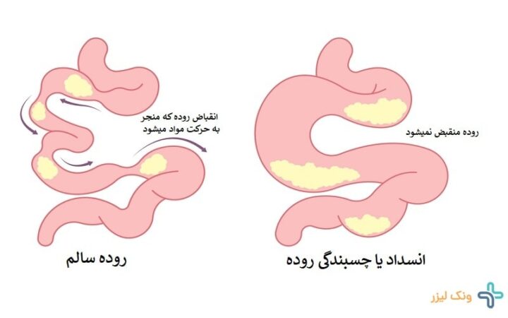 انسداد روده
