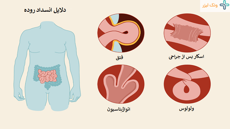 علت چسبندگی روده
