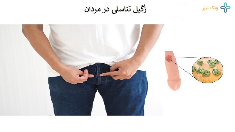 زگیل تناسلی مرد
