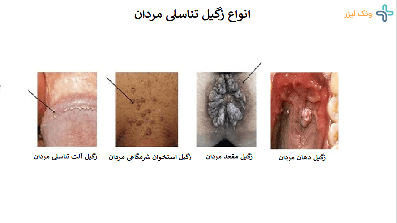 عکس زگیل تناسلی مردان