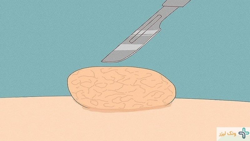 جراحی زگیل تناسلی