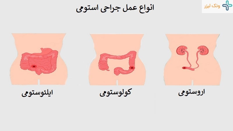 انواع استومی