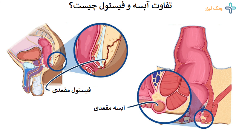 فرق آبسه و فیستول مقعدی