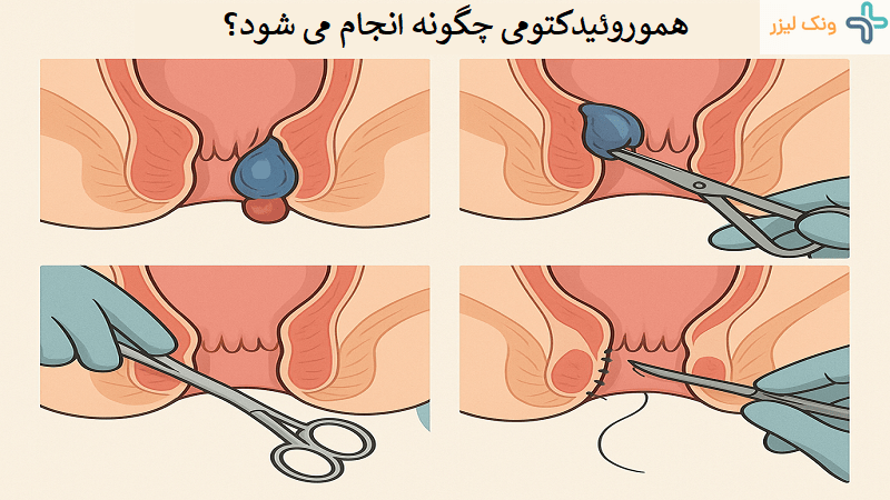 هموروئیدکتومی چیست