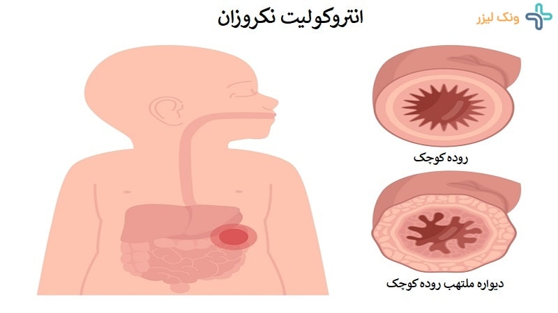 انتروکولیت نکروزان